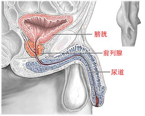 前列腺囊肿会发展为前列腺肿瘤吗 